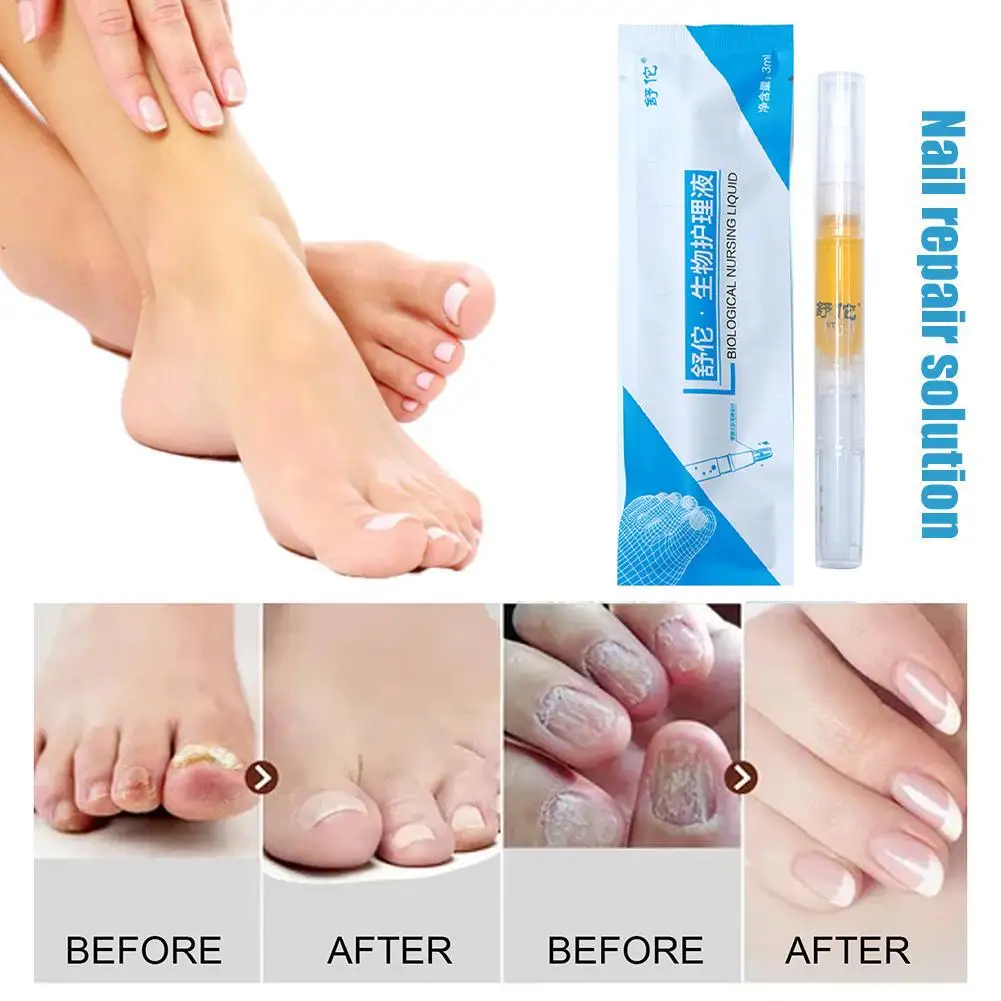 Nail Fungal Repair Liquid Pen Onychomycosis Paronychia Serum Fungus Foot Hand Removal Nail Toe Anti Gel Repair Fungus Infec Z3V0