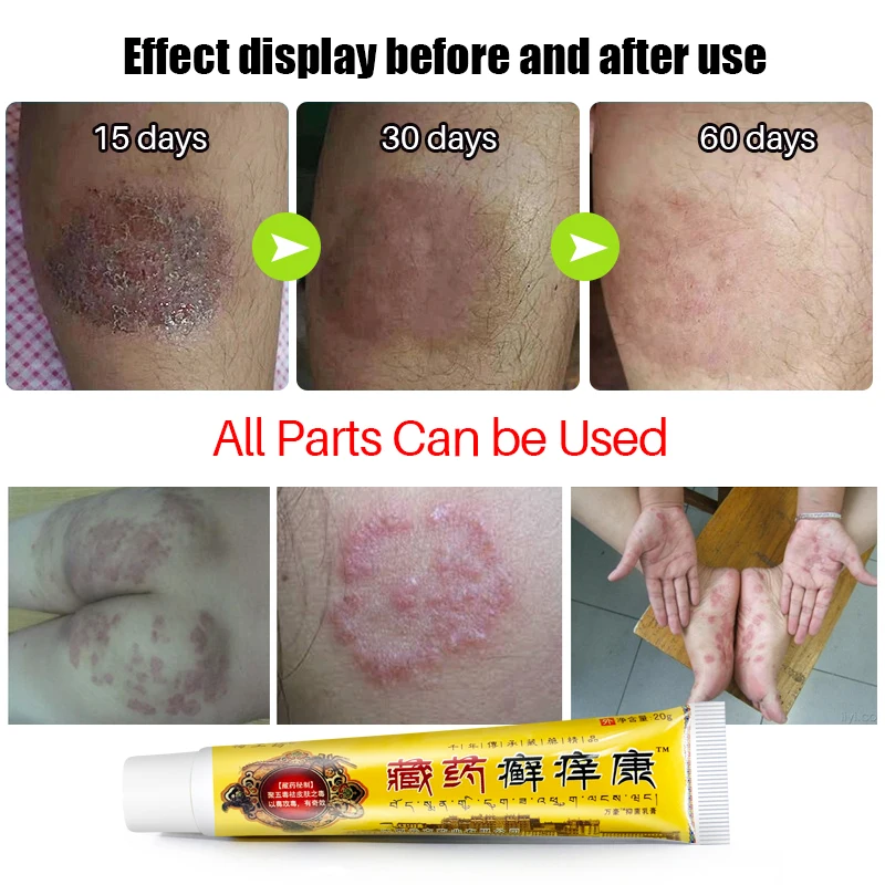 1Pcs Psoriasis Cream Antibacterial Herbal Plaster Dermatitis Eczematoid Eczema Ointment Treatment Psoriasis Skin Care Cream S050