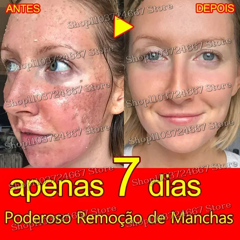 

Freckles Removal Remove Facial Spots Skin Dark Spot Remove Melasma Age Spots Sunspots Whitening And Freckle Removing