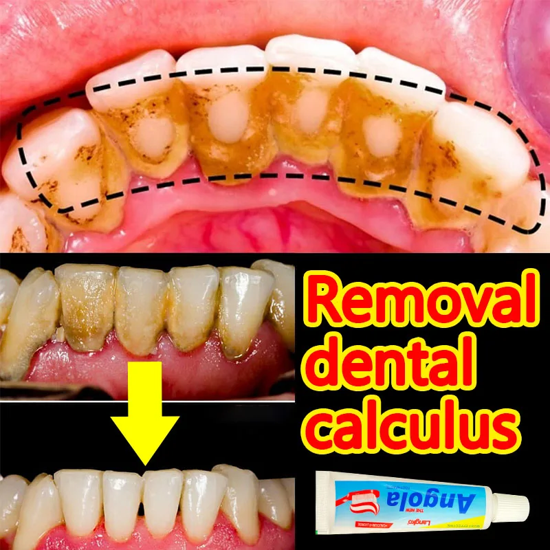 

Dental Calculus Toothpaste