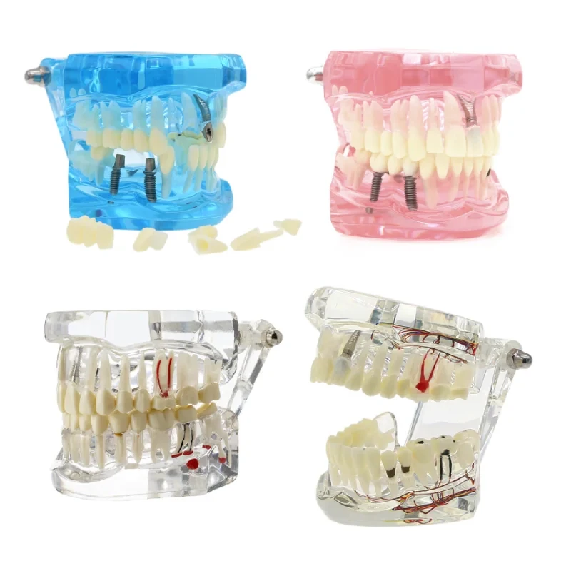 

Dental Teeth Model Implant Bridge Restoration Neural Repair Pathology Study Demo Removable Teeth M2001