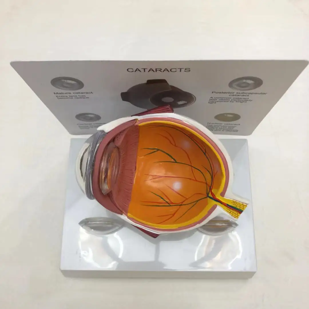 Cataract Eye Model Anatomical Disease Demonstration for Medical Teaching