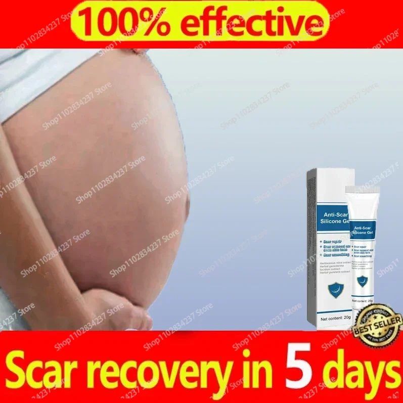 Cream For Pregnancy Stretch Marks Removal Eliminate Red White Old Stretch Marks Oil 1