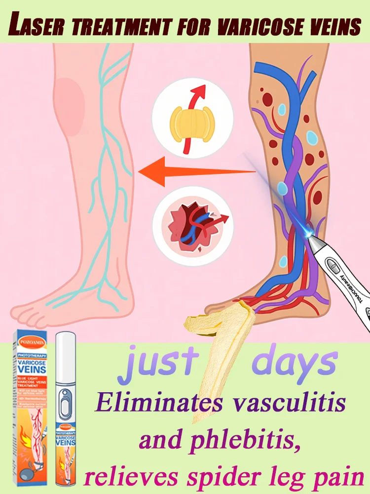 Laserowe leczenie żylaków, sprzęt medyczny, bezbolesne leczenie pajączków i krwawienia w nogach.