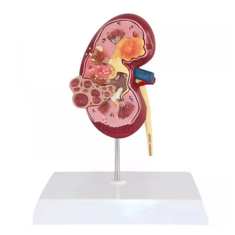 

Kidney Pathologies Anatomical Model Human Body Organ Anatomy of Diseased Kidney for Doctors Office Educational Teaching Supplies