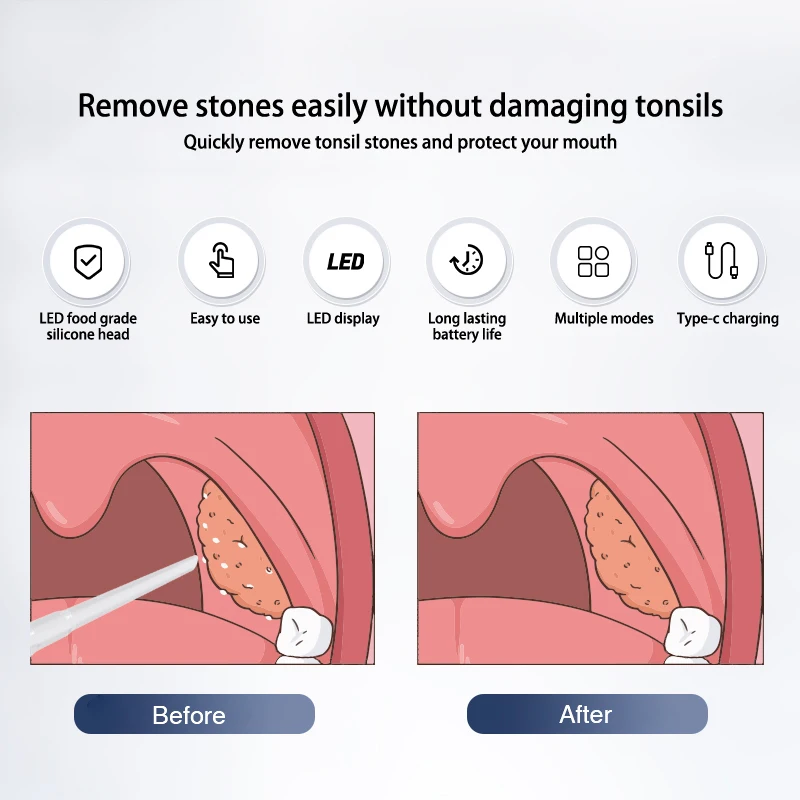 1Set Electric Tonsil Stone Remover Tonsil Stone Removal Kit Vacuum With Irrigation Syringe Instant Suction Tonsil Stone Removal