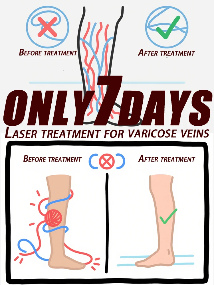 

Laser treatment for varicose veins,ᴍᴇᴅɪᴄᴀʟ grade equipment, painless treatment for spider veins and blood in the legs