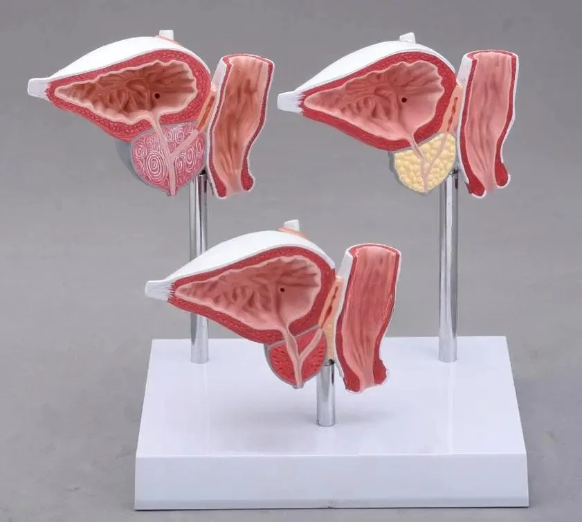 Prostate pathology teaching model Prostate lesions anatomy education teaching model