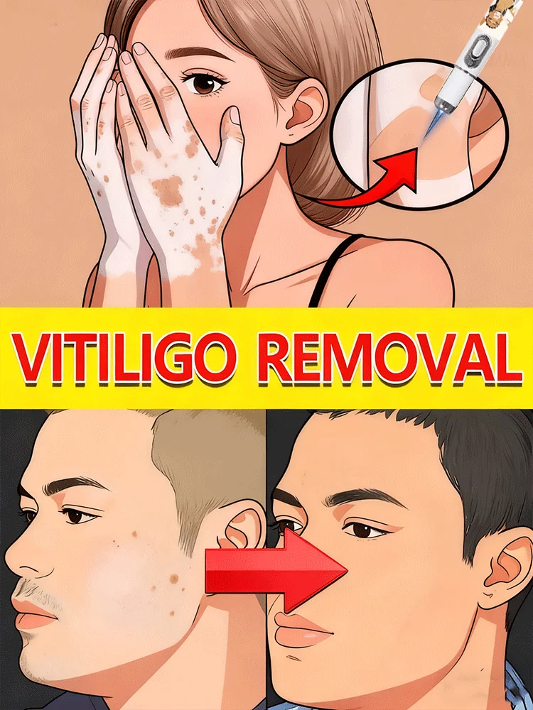 Bolígrafo de luz azul para Vitiligo, gran oferta 20225, herramientas para el cuidado del Vitiligo, unisex, generación-2, juego combinado de comidas