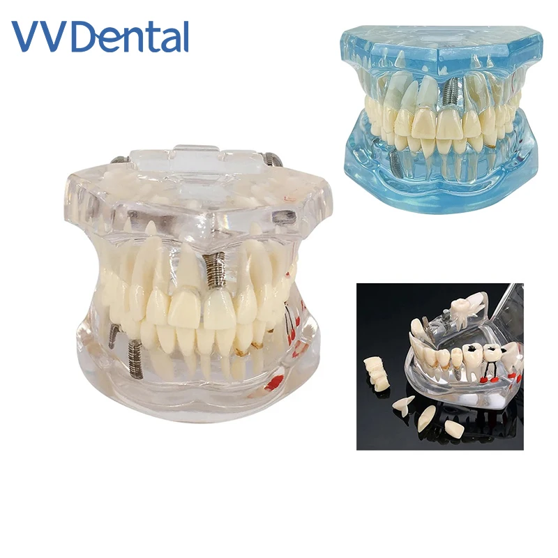 

Модель зуба VVDental для лечения зубов, имплантат Typodont со съемным мостом для восстановления зубов, обучающие исследования