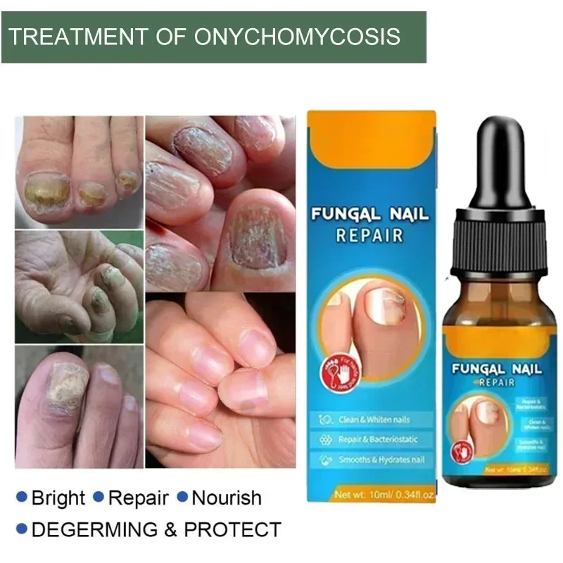 Extra Strength Toenail Fungus Treatment Nail Fungus Solution for Toe Nail & Fingernails