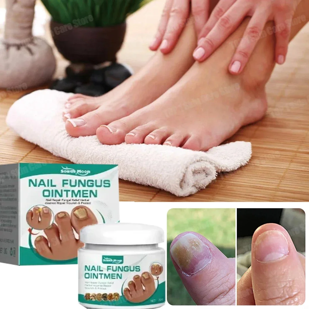 Nail Treatment Onychomycosis Paronychia Anti Fungal Nail Infection Toe Nail Fungus Treatment Essential Oil