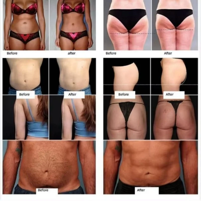 جديد 2025 Emslim Nova Aesthetics Emt آلة التخسيس Rf 4 مقابض نحت الجسم العضلات Emslim Neo مع Rf حرق الدهون الصالة الرياضية استخدام