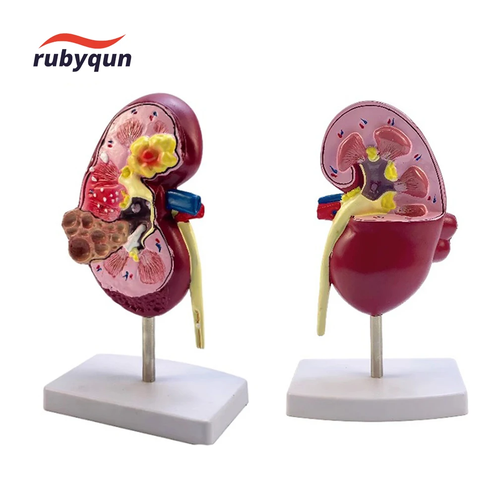 1 Pcs Life Size Kidney Pathologies Model Human Body Anatomy Replica of Diseased Kidney Medical Office Supplies Educational Tool