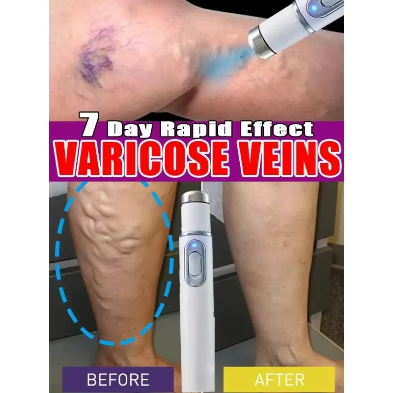 Varicose Veins Treatment  Soothes burning or itching Improve blood circulation Reduces venous pressure Diminishes  spider veins