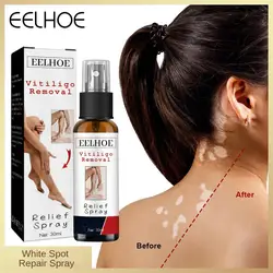 Лечебный спрей для Vitiligo White Spot, увлажнение, уменьшение белых пятен, лечение заболеваний лейкоплакии, пигмент меланина, ремонт, белая бирка, уход