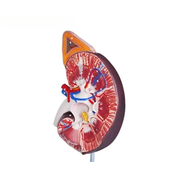 High-quality hot-selling diseased kidney anatomy model