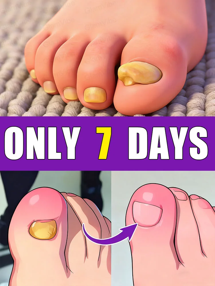 

2026 Bestselling Product • Free Shipping • 10ml Tea Tree Nail Care Solution