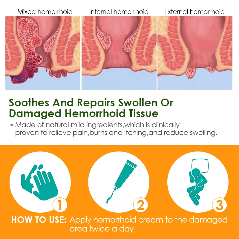 1 шт. мазь от геморроя, натуральная травяная медицина, стерилизующий крем, снятие боли в анусе, внутренние сваи, терапия наружной трещины S102