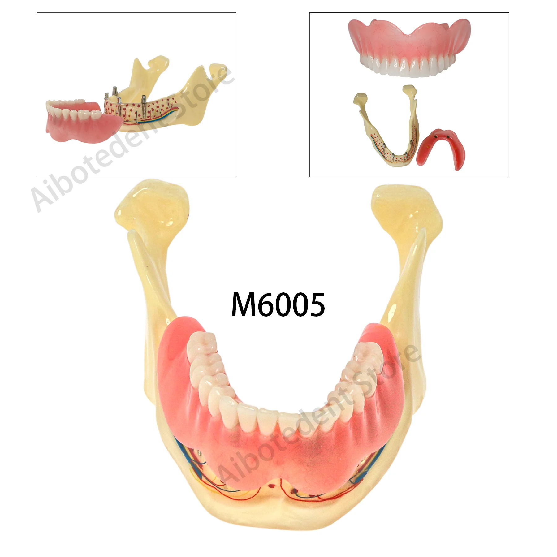 

Dental Teeth Model Jaw with Overdenture Typodont Model Transparent Bone Implant Positions