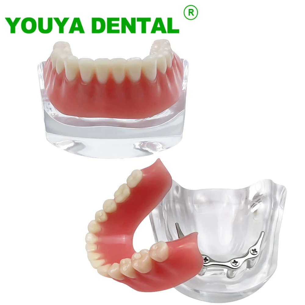 Dental Teeth Model With Implants Lower Jaw M6008 Silver Bar Type Overdenture Model Typodont Restoration Treatment Demo Study