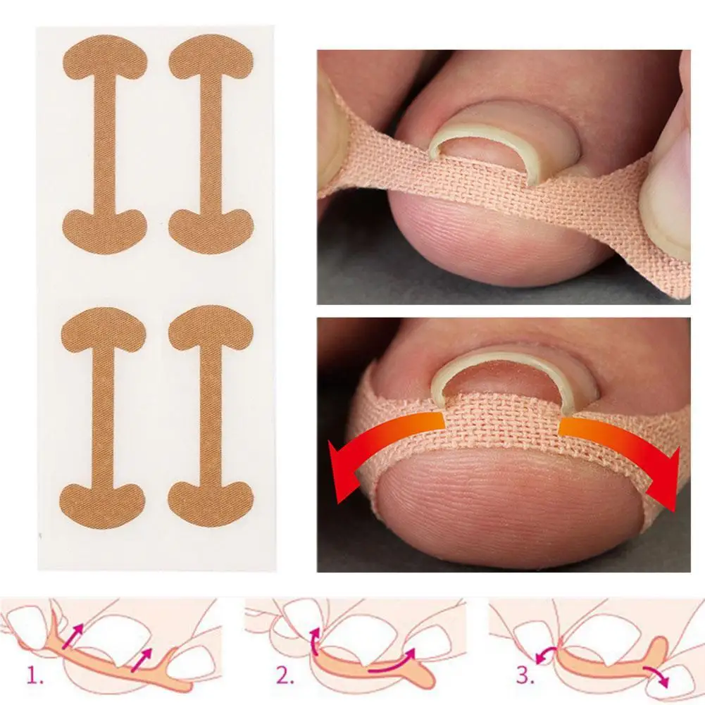 4pcs Nail Correction Stickers Toenail Patch Ingrown Toenail Corrector Patch Paronychia Treatment Recover Corrector Pedicure Tool