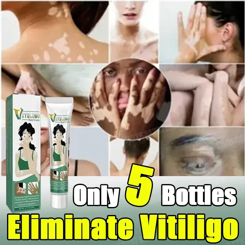 Orginal Whitening Skin Cream Vitiligo Bleaching Creame Face Body Dark Spots Remover Melanin Removal Brightening Decolorizing