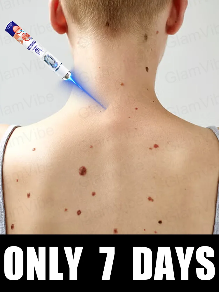 

blue light pen solve warts, hot sale wart care tools