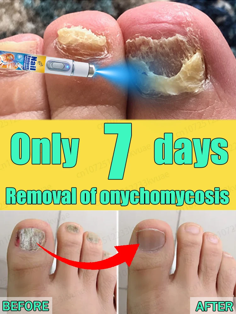 

Technology changes life and says goodbye to onychomycosis