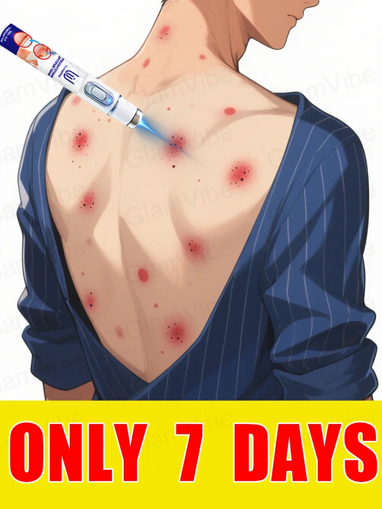 blue light pen solve warts, hot sale wart care tools