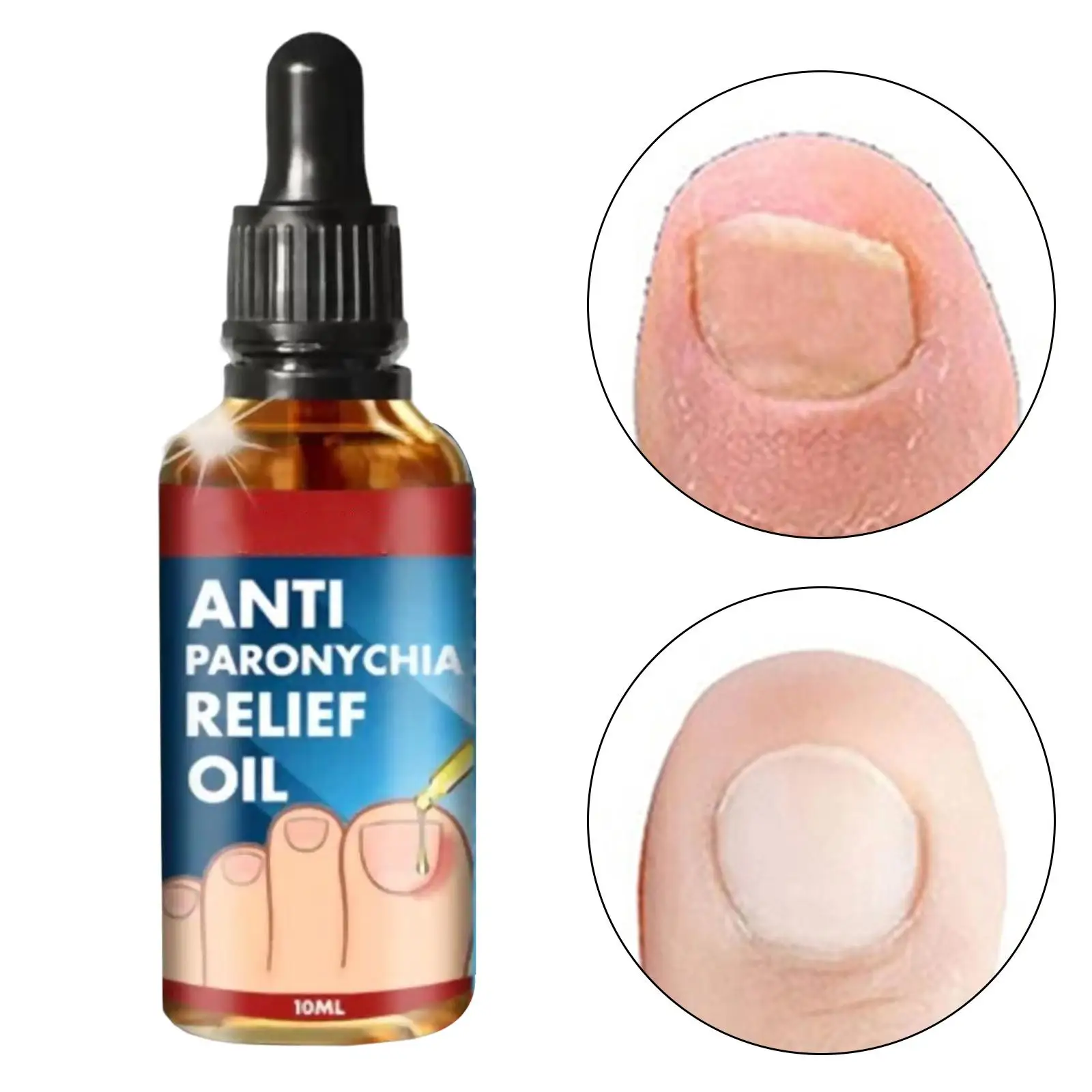 Ingrown Toenail Tratamento Óleo, Solução Reparação, Nutritivo para unha, 10ml