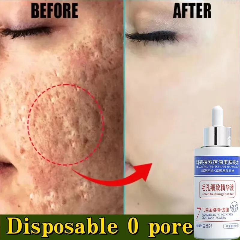 

Pore Shrinking Serum Acne Pit Repair Product for Men Women Remove Acne Print Scar Large Pore Anti-inflammatory Smooth Skin Cream