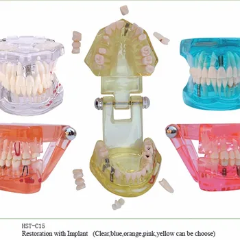 1 piece dental implant disease teeth model with restoration bridge teeth dentist medical dentist education and teaching model