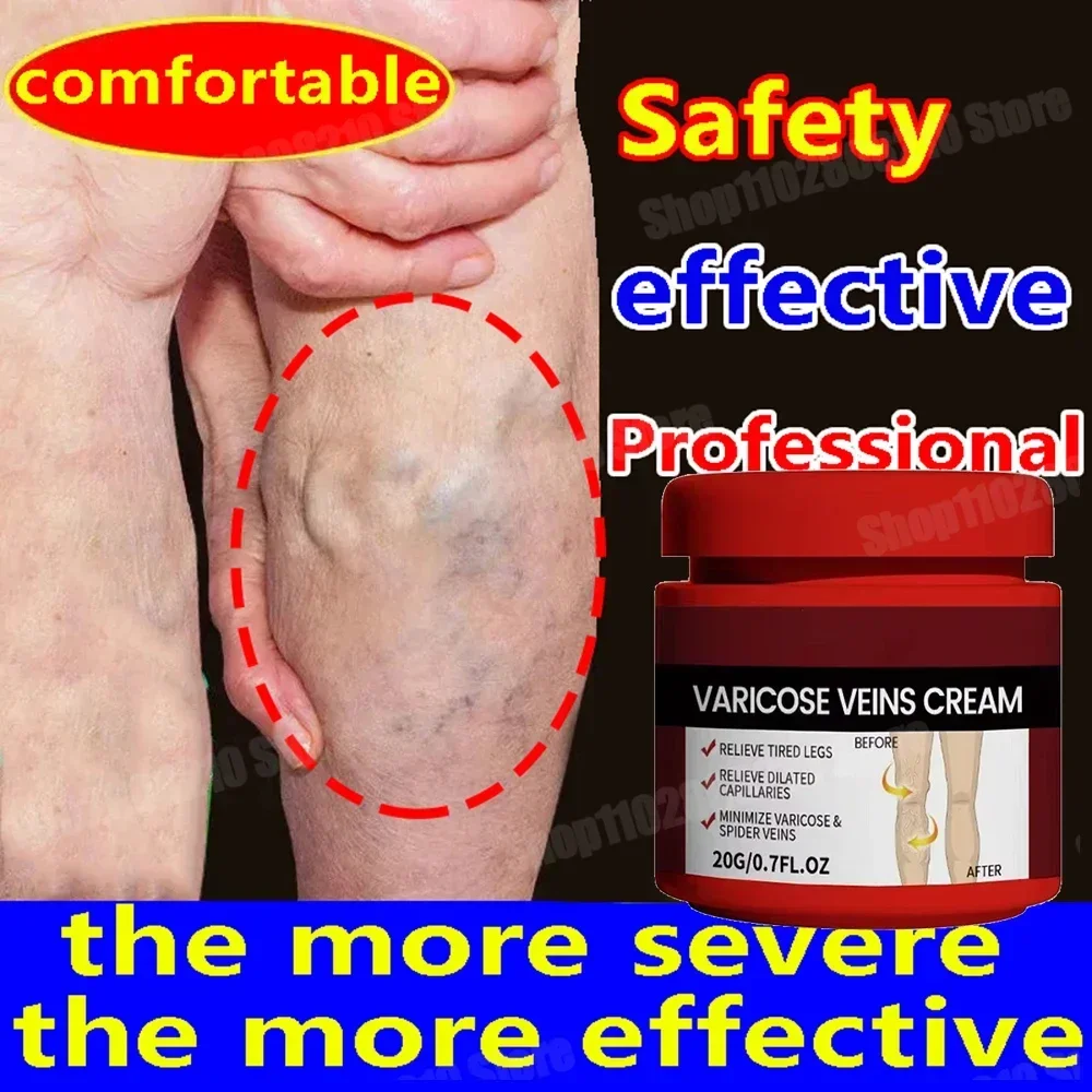 

Leg varicose veins, spider vein expansion cream, enhance capillary health, improve blood circulation