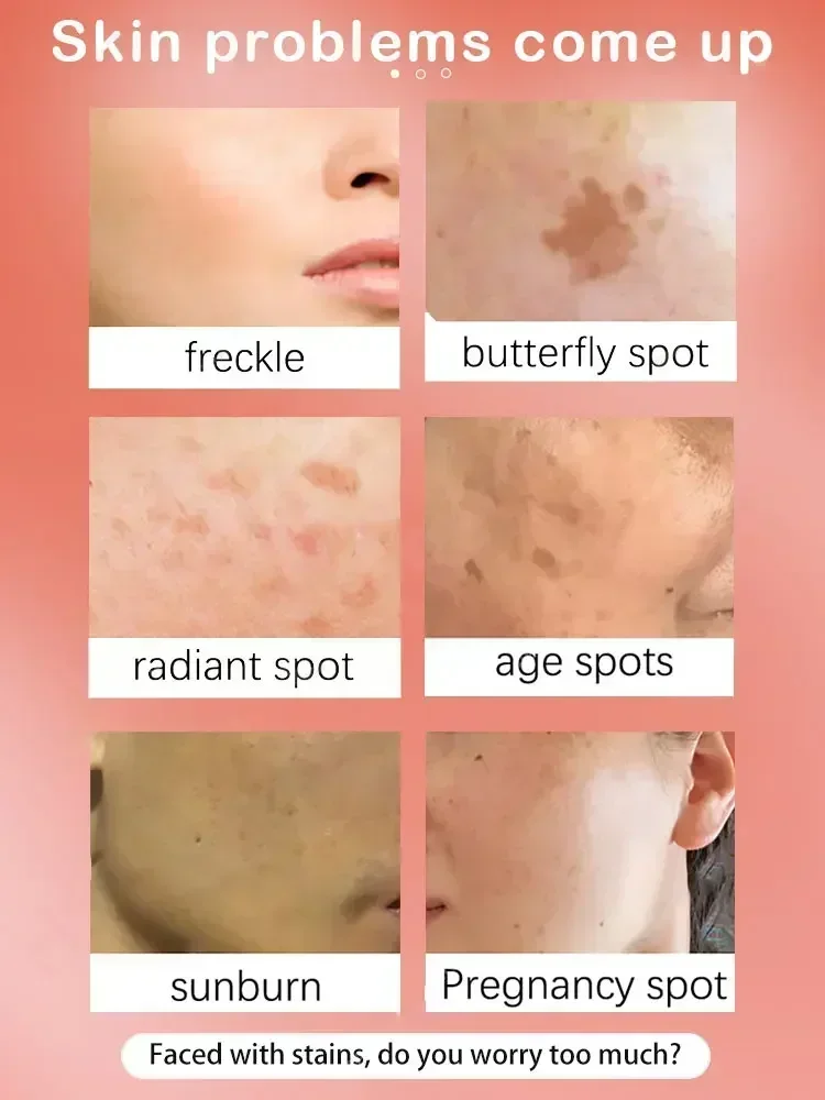 Spot Removal Cream Freckles Removal Lighten Melanin Fade Melasma Remove Facial Spots Dark Spot Remover