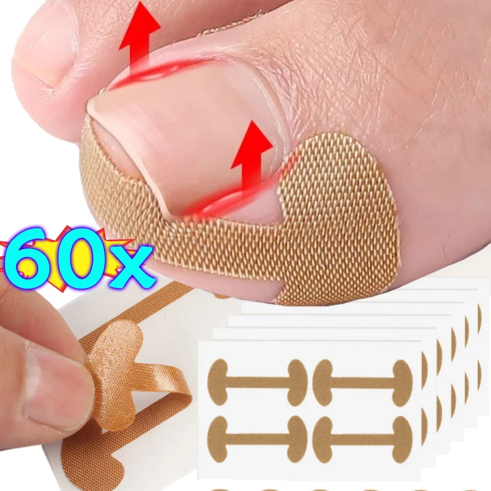 20/40/60Pcs Ingrown Paronychia Toenail Corrector Strips Anti Fungal Nail Correction Stickers Anti Infection Nail Treatment Patch