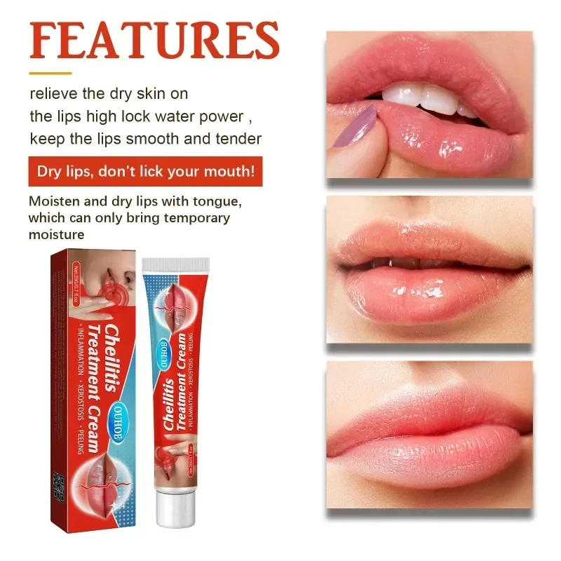 Cold Sores Lip Cheilitis Treatment Cream Herpes Antibacterials Ointment Chapped Lips Wrinkles Rehydration Plaster lip care