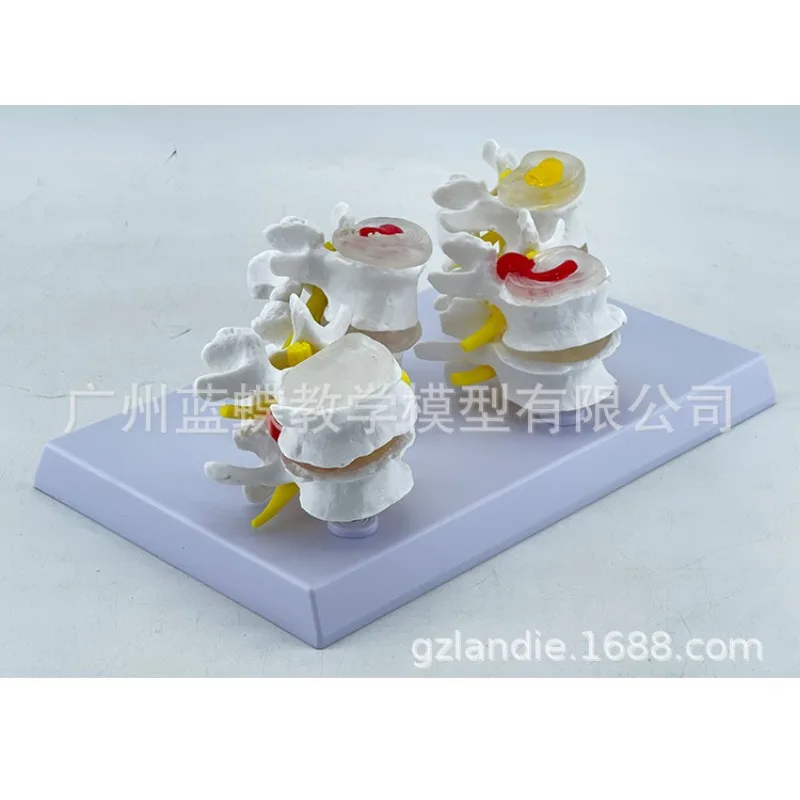 Skeleton Anatomical 4-stage Osteoporosis Vertebrae Anatomical Model Nursing Model Skin In Trauma Lumbar Degeneration Model