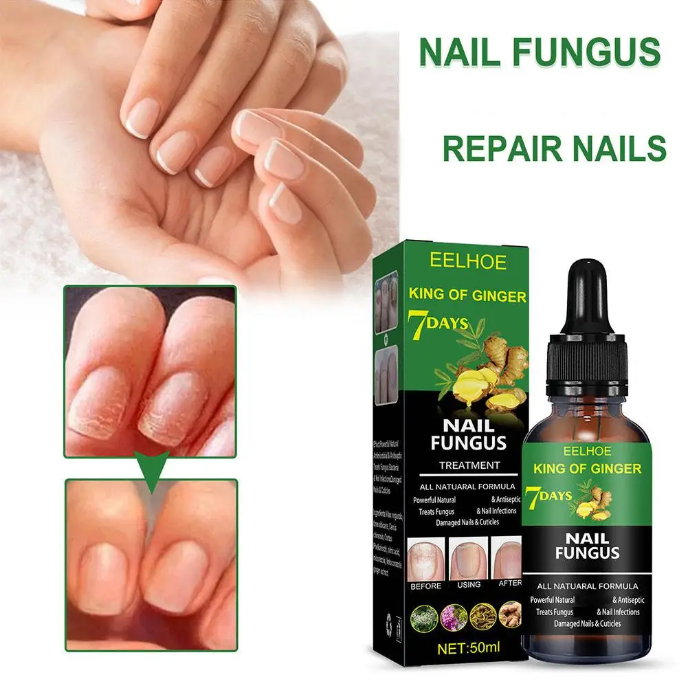 50ml Ginger Nail Fungal Treatments Feet Care Essencial Onychomycosis Infections Liquid Toe Nail Foot Paronychia Repair Anti R7U5