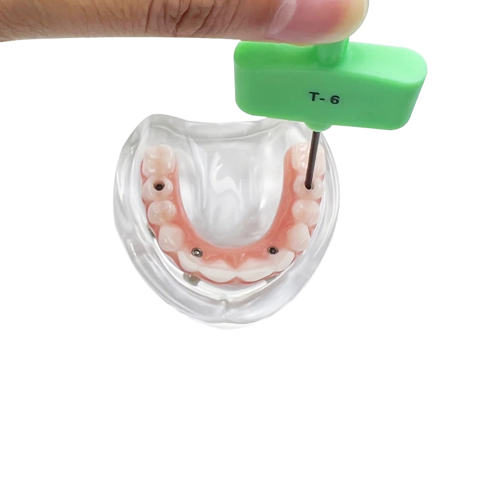 

1set Dental Implant Model with 4 Removable Screws Upper Lower Jaw Overdenture Dental Teeth Model for Teaching Studying Practice