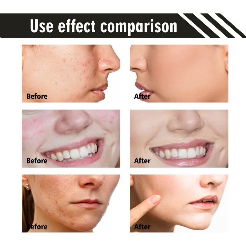 3 em 1 acne cuidados com a pele gel controle de óleo limpeza profunda clareamento acne cravos marcas hidratante suavização gel de reparação da pele