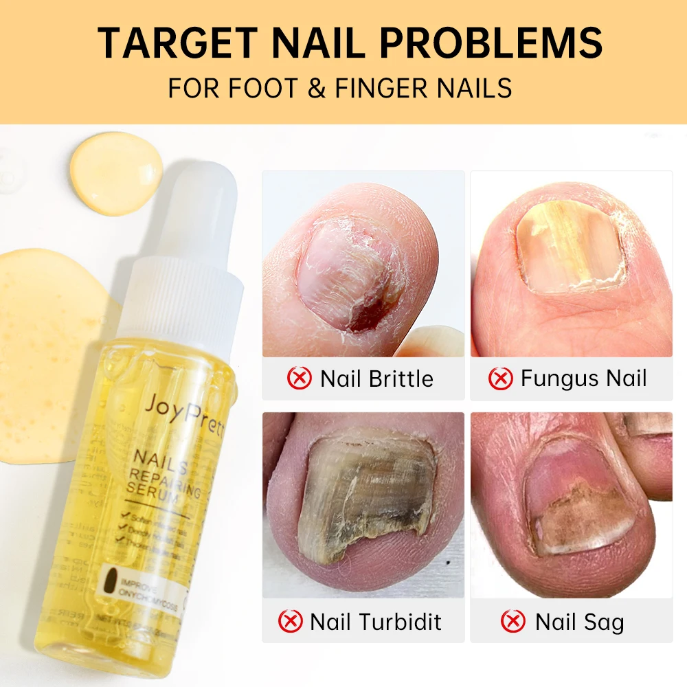 JoyPretty-Nail Fungal Tratamento Soro, Anti Infecção, Reparação Essência, Renovação do prego Nutritivo Gel, Unha Cuidados Produtos, Beleza