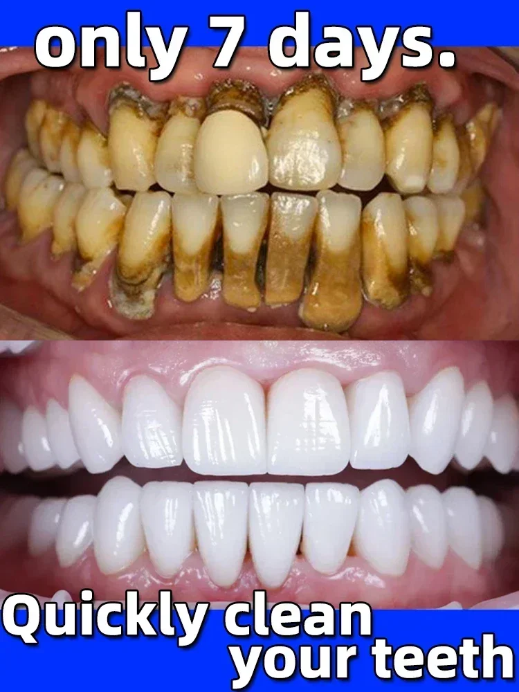 Remover Dental Calculus Whitening Teeth Mouth Odor Removal Bad Breath Preventing Periodontitis Deep Clean Whiten Toothpaste