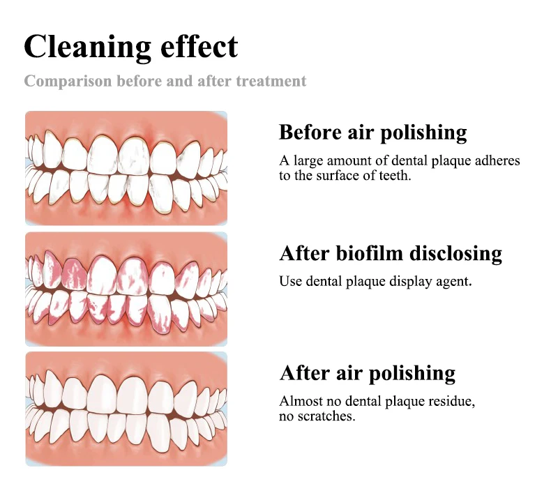 VV Dental Air Polisher Dental Spray Jet Airflow Zahnaufhellung für Mundhygiene Reinigung Zahnarzt Odontologie Sandstrahlwerkzeuge – Detail 5