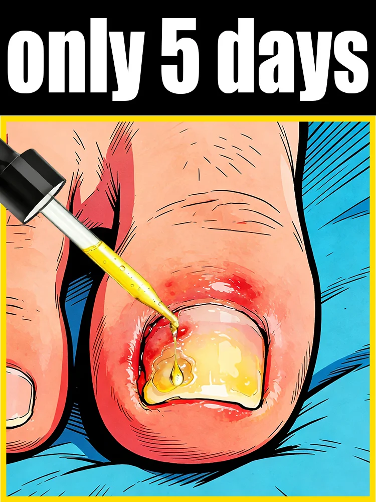 Eʟɪᴍɪɴᴀᴛᴇ ғᴜɴɢᴀʟ ɴᴀɪʟs Rapid penetration, restoring nails to their natural shine. Say goodbye to fungal nails
