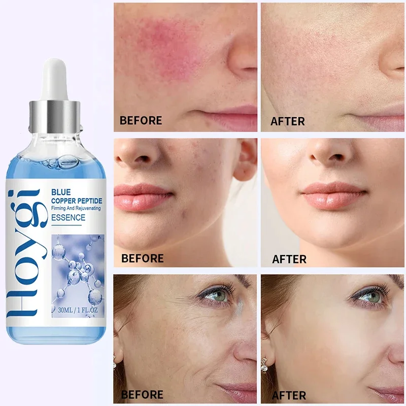 Copper Peptide Uglies: How I Fixed My Dull, Sagging Skin with Hoygi Blue  Copper Peptide Serum