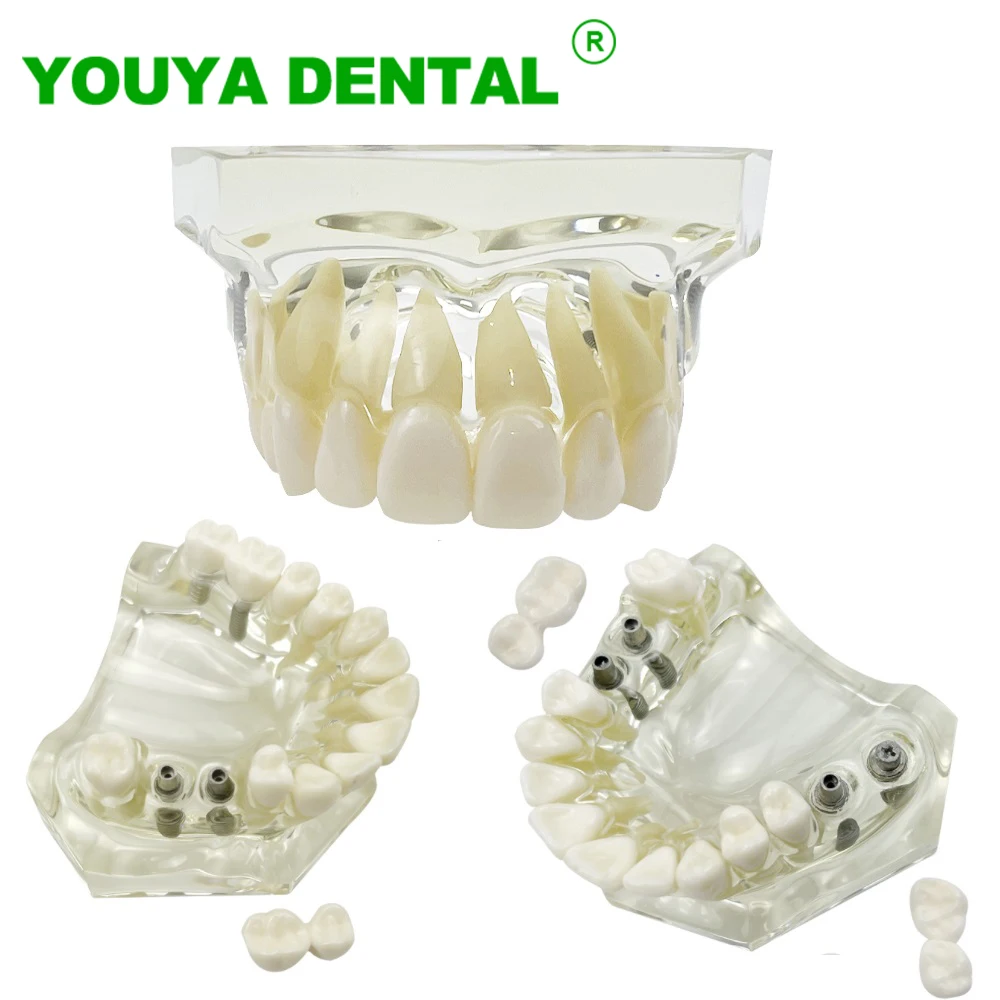 Dental Model Maxillary With Implant Removable Teeth Restoration Bridge Typodont Upper Jaw Demonstration Model Dentistry Products