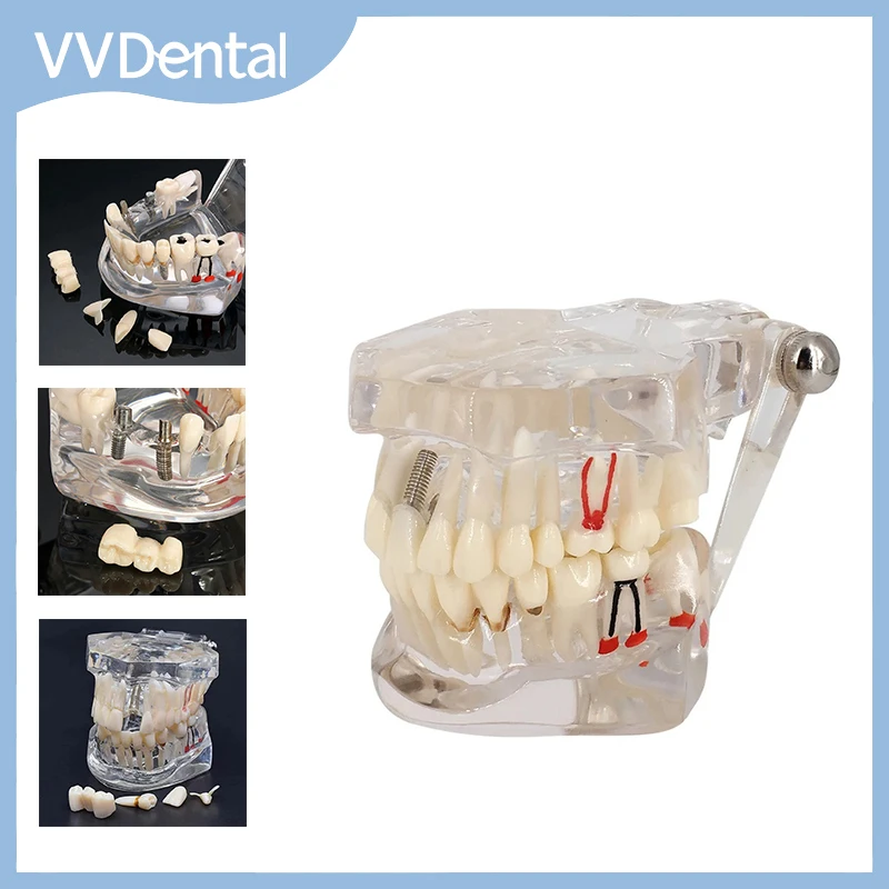 

VVDental Disease Teeth Model Implant Disease Of Teaching Demonstra Student Learning Researching Medical Repairable Resin Models