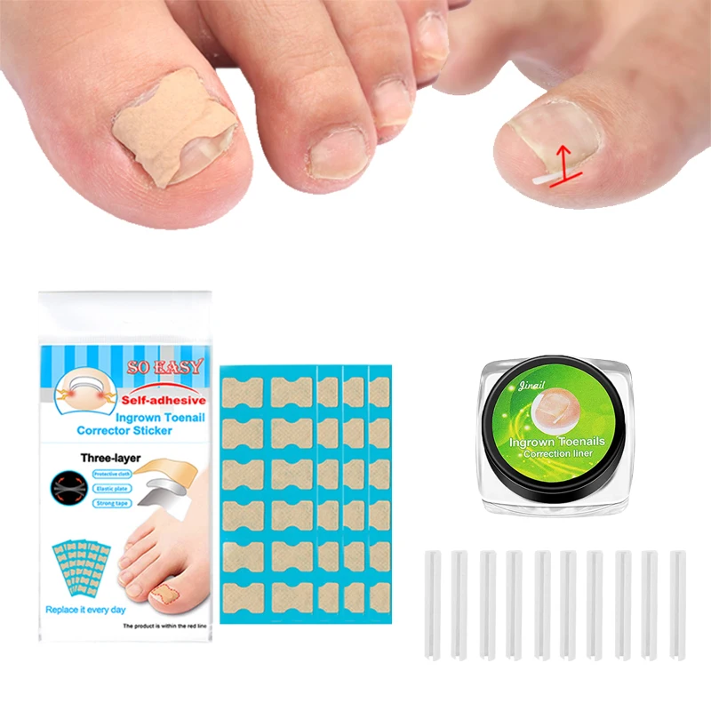 

Ingrown Nail Toenail Correction Patch Toenail Corrector Toe Separator Correction Tool Ingrown Toenail Treatment Patch Separators