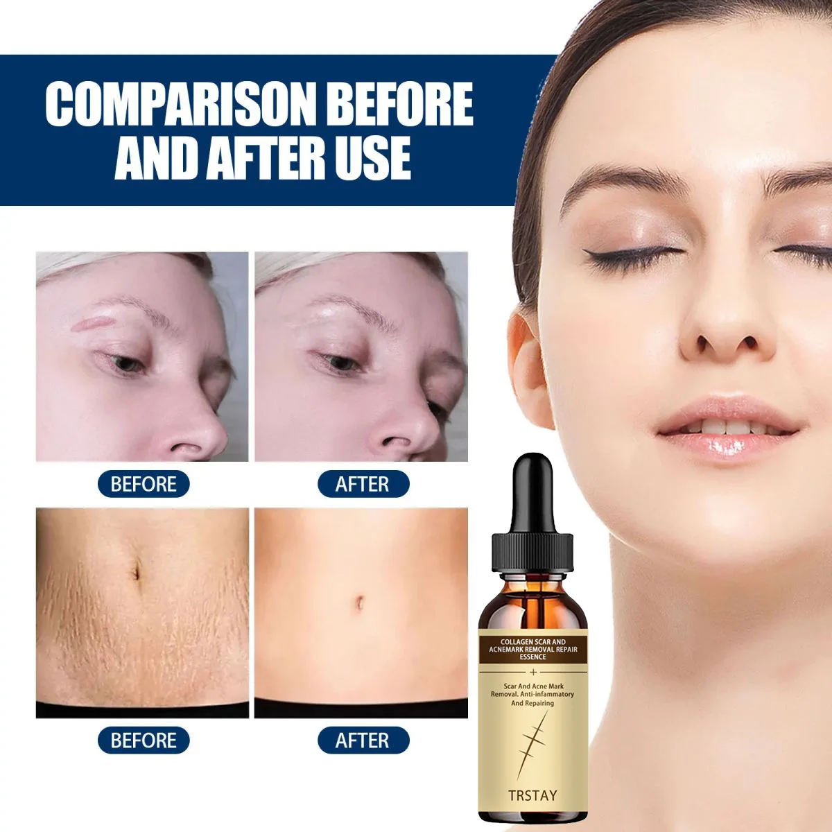 Aichun scar lightening hyaluronic acid stock solution skin moisturizing and moisturizing imprint lightening stock solution